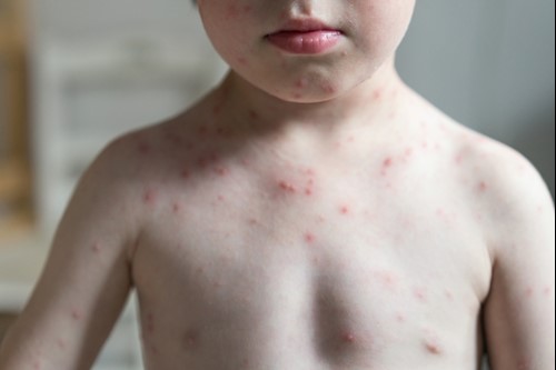 viral rash